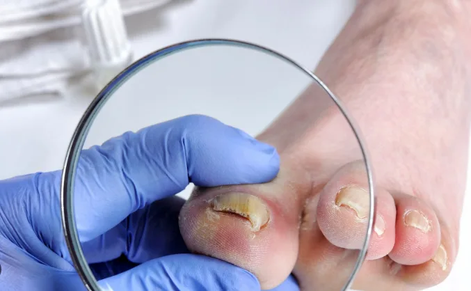 Evaluación de micosis en las uñas