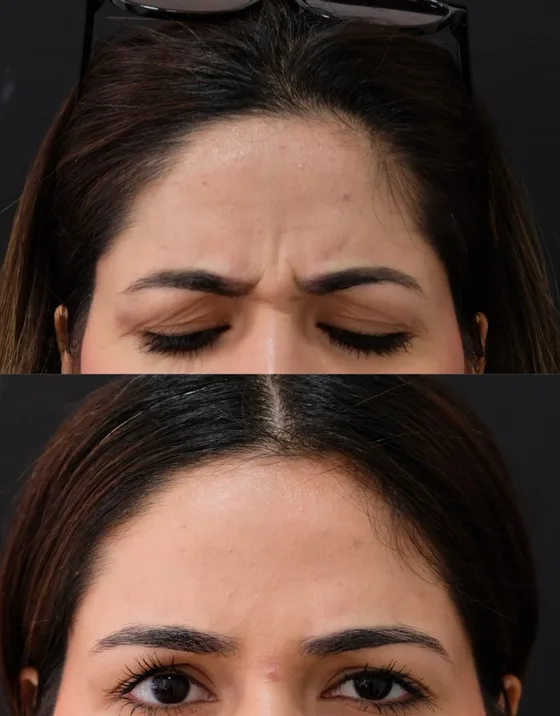 Antes y después de toxina botulínica en el entrecejo